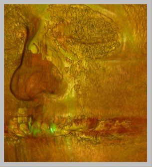 Darstellung der Flügelknorpel und des knöchernen Nasengerüstes, hier nach Fraktur. Cone beam CT (DVT)